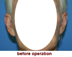 plastic-surgery-prominent-ear 